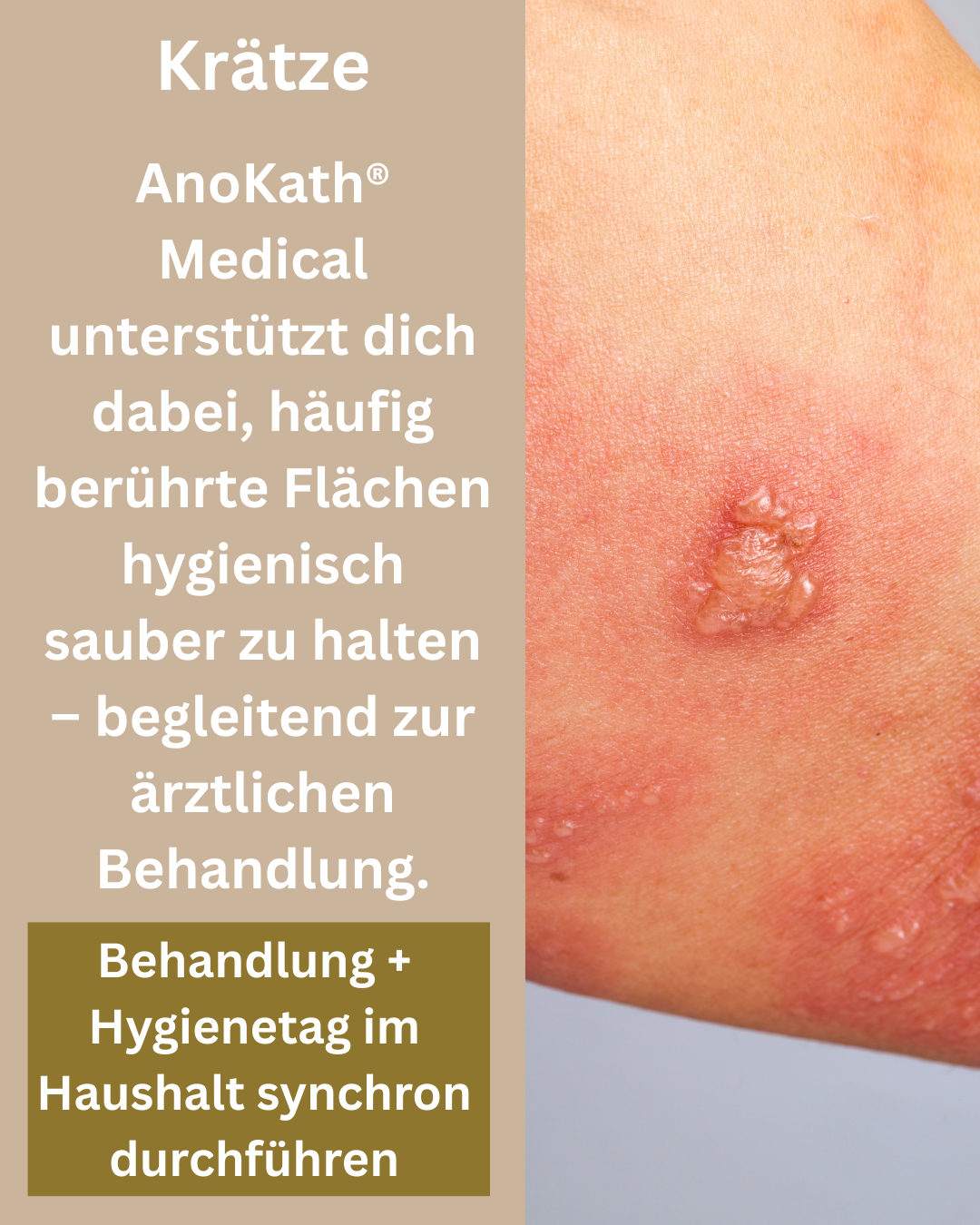 Krätze